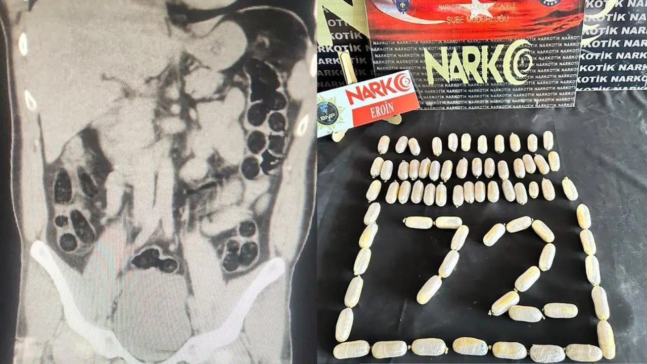 İranlı şüphelinin midesinden 76 paket eroin çıktı