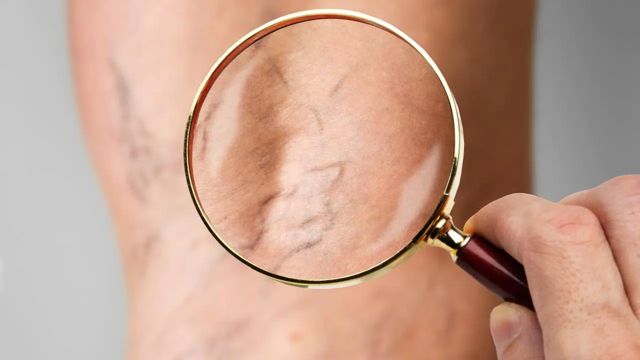 Sıcak havalar varis hastalığını tetikliyor