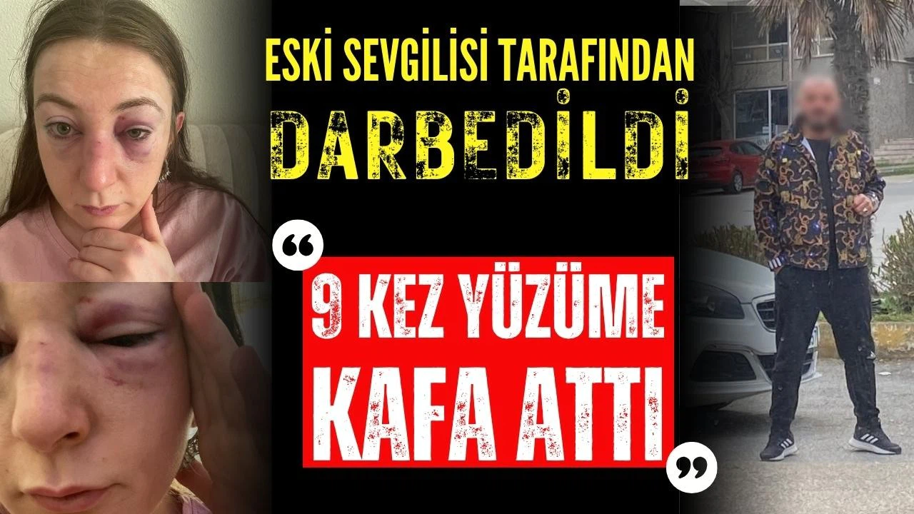 Eski sevgilisi tarafından darbedilen Sibel: 9 defa yüzüme kafa attı