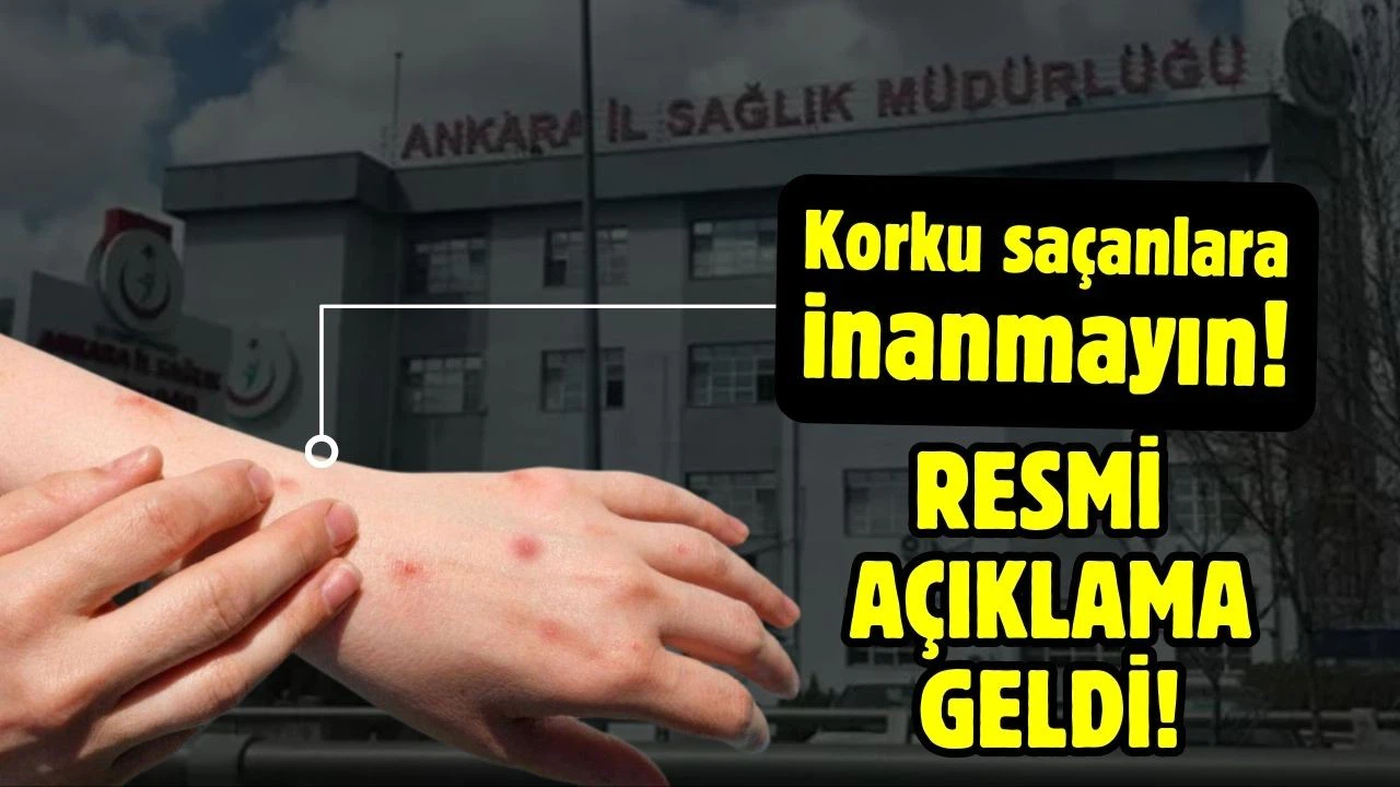Ankara'da maymun çiçeği görüldü iddialarına yalanlama!