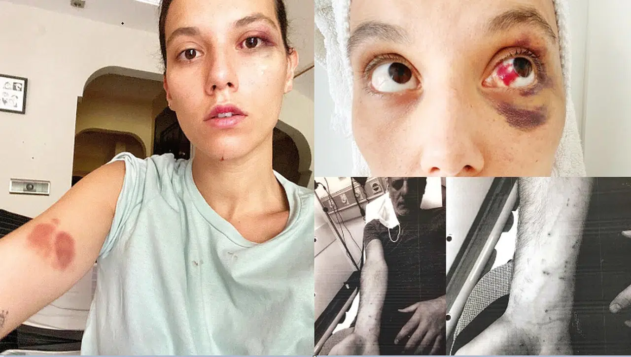 Sevgilisini döverken kolu 'çizilmiş'!