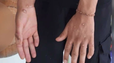 İstanbul Sultangazi'de maymun çiçeği şüphesi