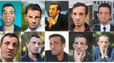 Yüz nakli oldu, aynalarla barıştı!