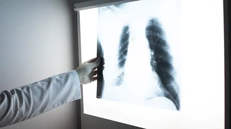 Dünyada yaygın, Türkiye’de azalan tehdit: Tüberküloz