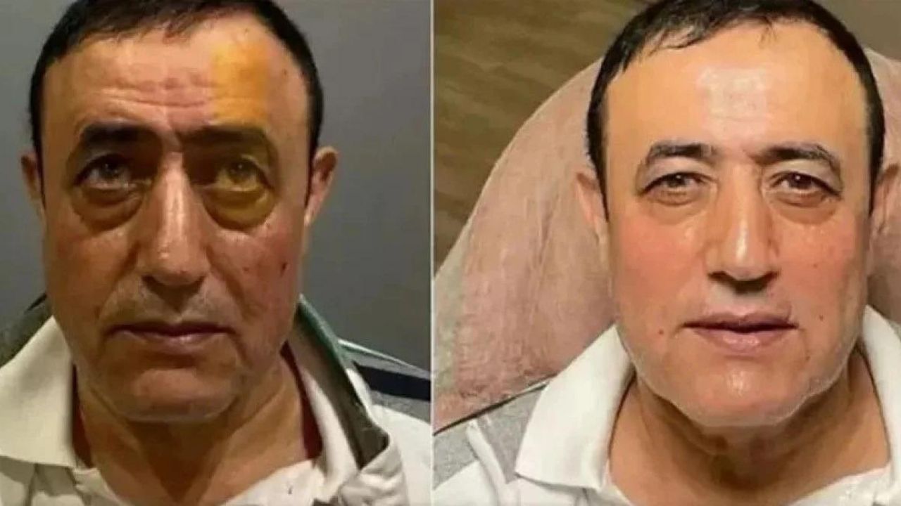 Estetikliler kervanına ünlü şarkıcı Mahmut Tuncer de katıldı! Tuncer, 10 yaş gençleşti 4