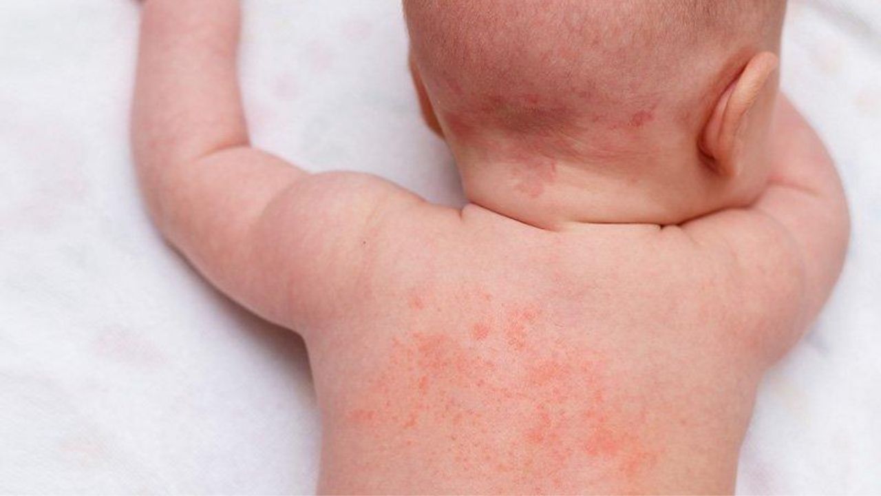 Türkiye’de her 17 çocuktan birinde besin alerjisi görülüyor! 16